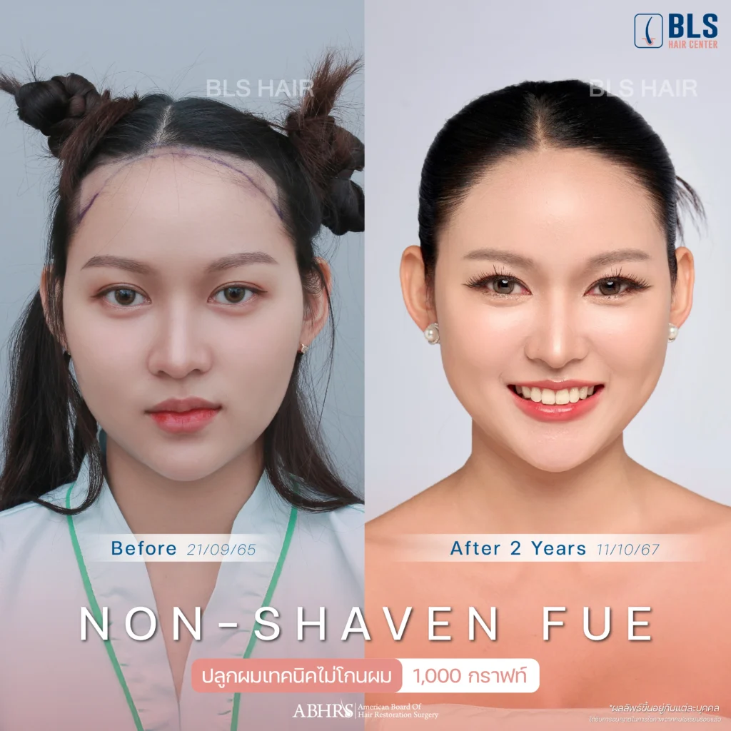 รีวิวปลูกผมเทคนิค Non-Shaven (FUE) ปลูกผมสั้น แบบไม่โกน