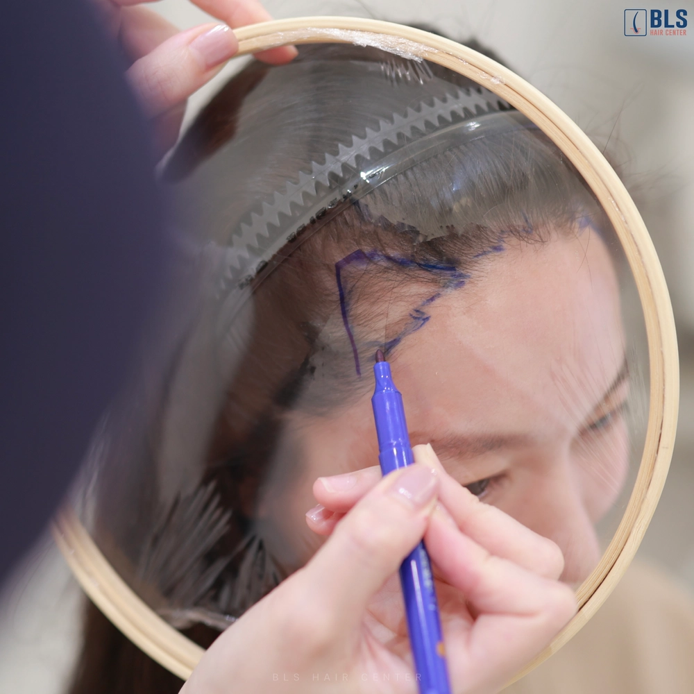 ปลูกผมยาว Long Hair ขั้นตอนดีไซน์แนวผม