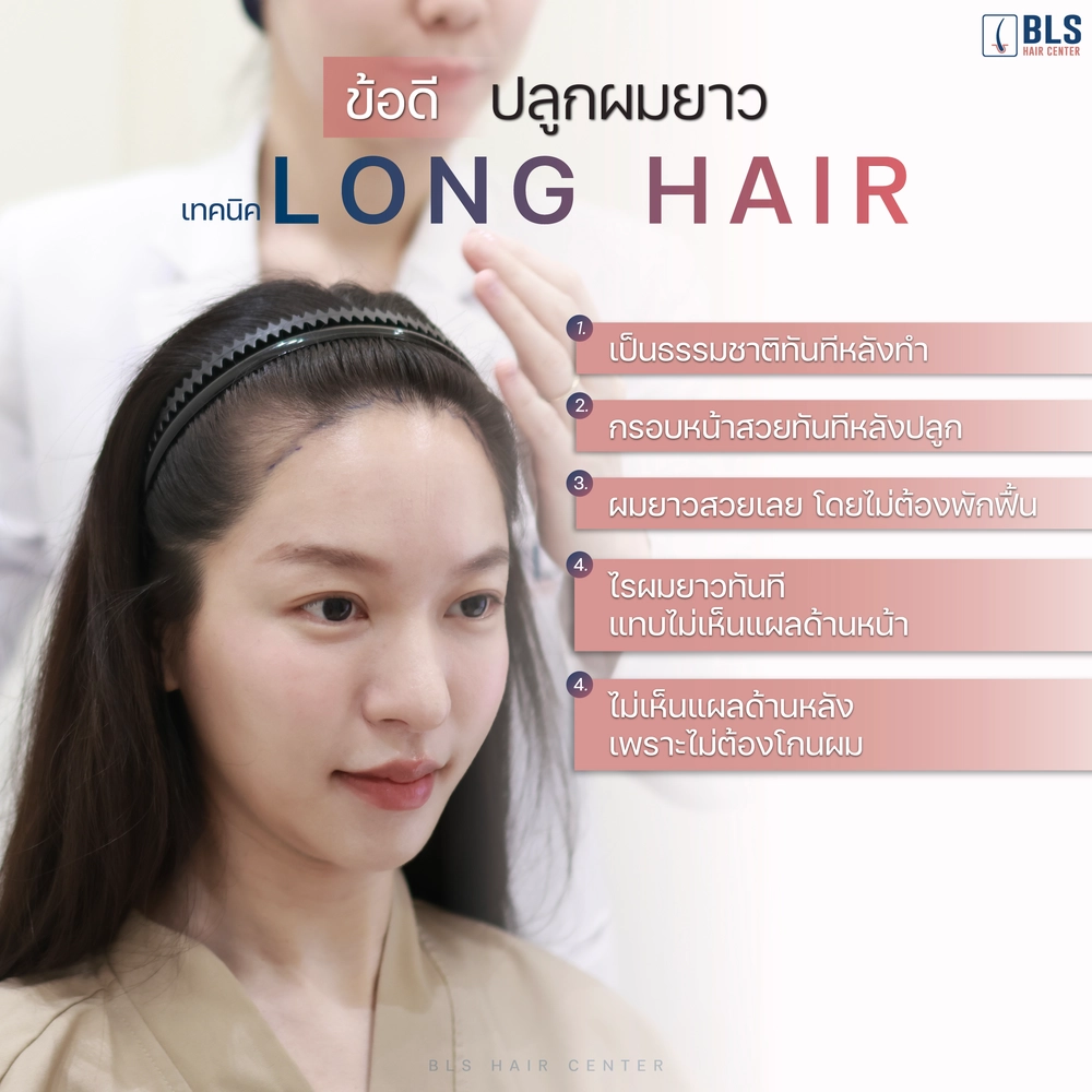 ข้อดีของการปลูกผม Long Hair