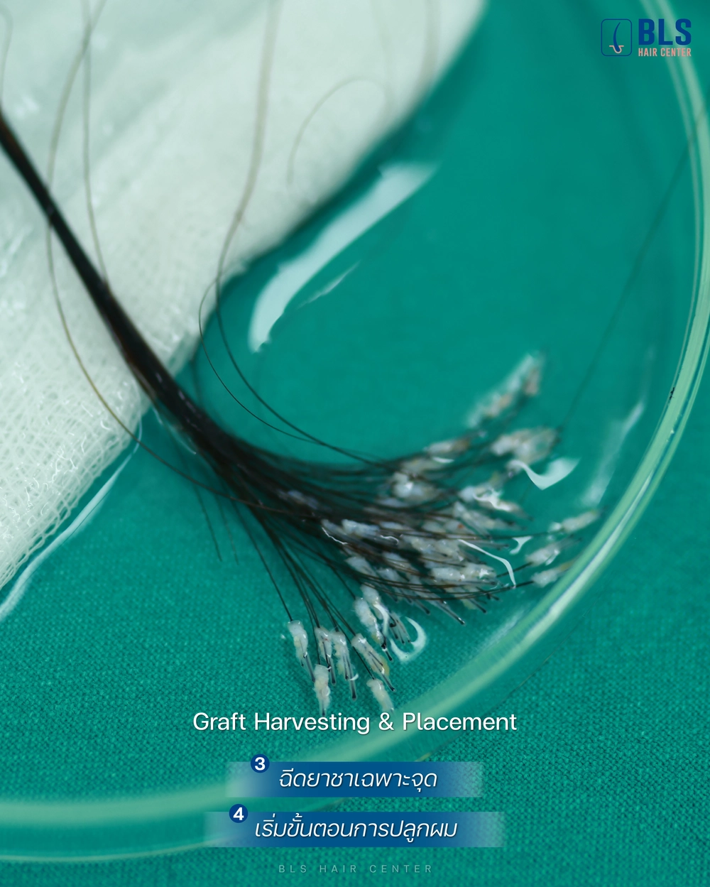 ขั้นตอนการปลูกผม