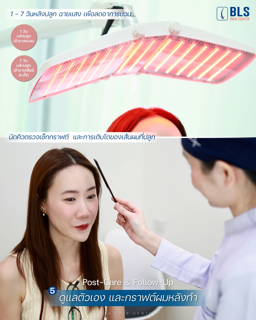 ขั้นตอนการปลูกผม