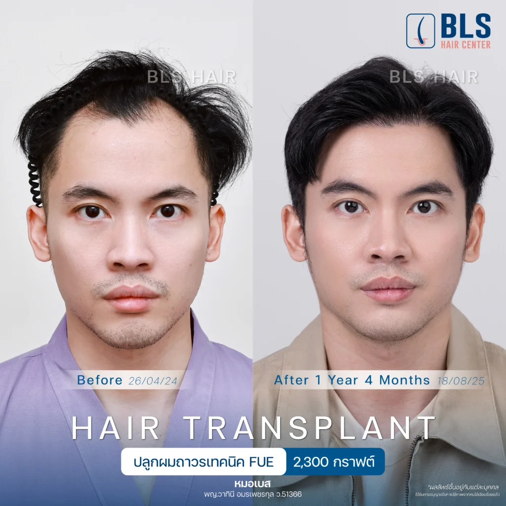 ชมรีวิวปลูกผมผู้ชาย แนวผมธรรมชาติ ดูดีขึ้น มั่นใจได้ที่ BLS Hair Center