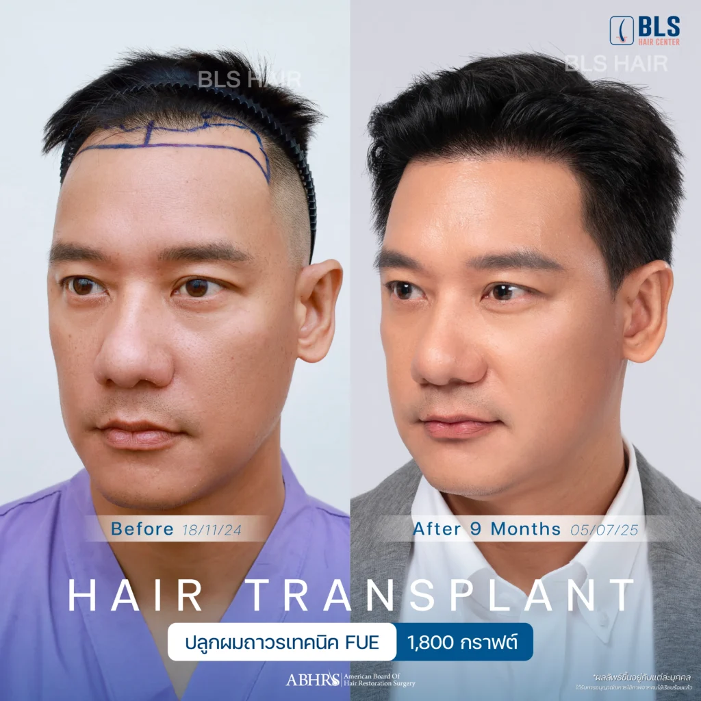 ชมรีวิวปลูกผมผู้ชาย แนวผมธรรมชาติ ดูดีขึ้น มั่นใจได้ที่ BLS Hair Center