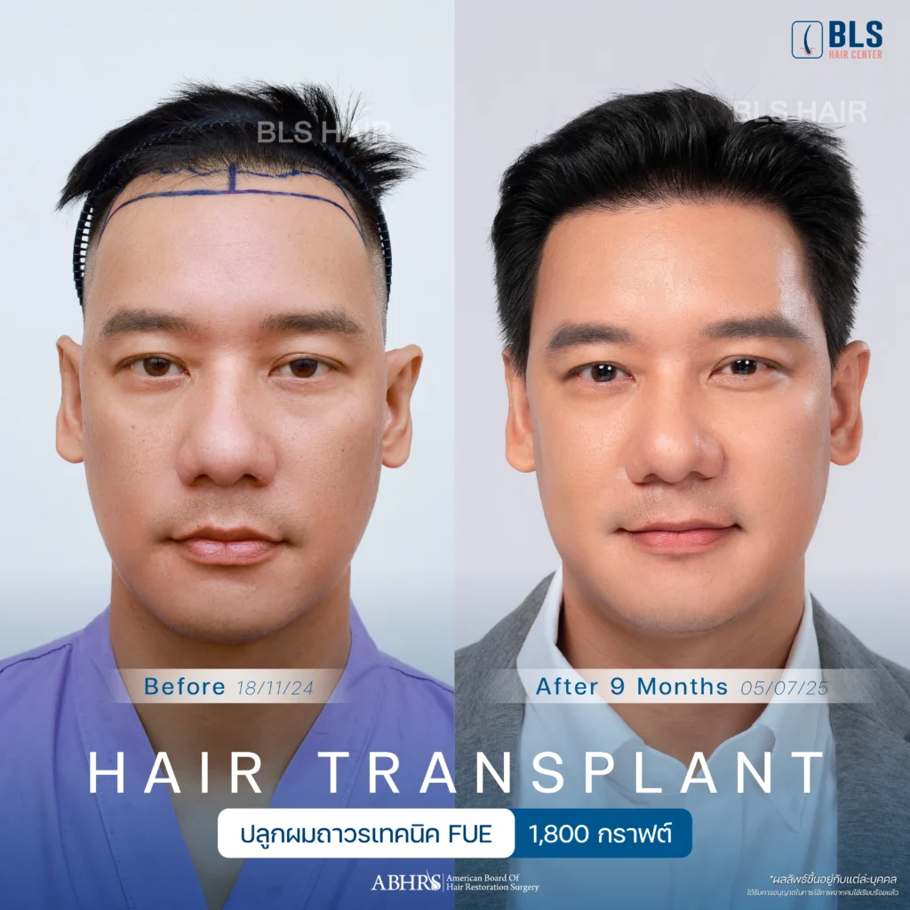 ชมรีวิวปลูกผมผู้ชาย แนวผมธรรมชาติ ดูดีขึ้น มั่นใจได้ที่ BLS Hair Center