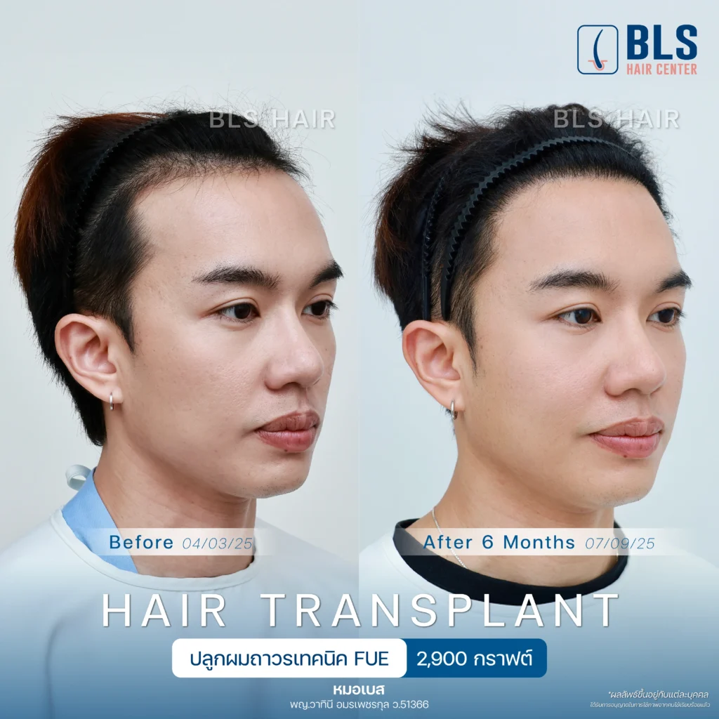 ชมรีวิวปลูกผมผู้ชาย แนวผมธรรมชาติ ดูดีขึ้น มั่นใจได้ที่ BLS Hair Center