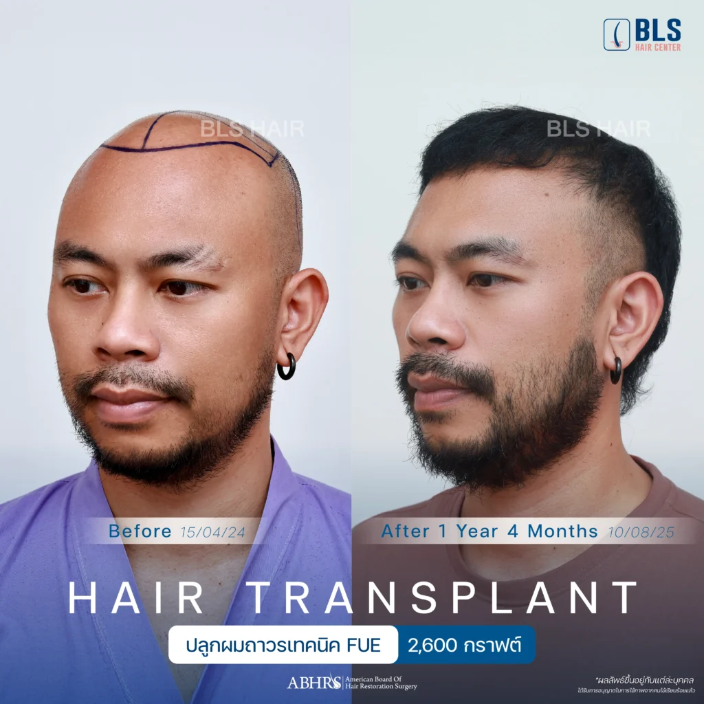 ชมรีวิวปลูกผมผู้ชาย แนวผมธรรมชาติ ดูดีขึ้น มั่นใจได้ที่ BLS Hair Center