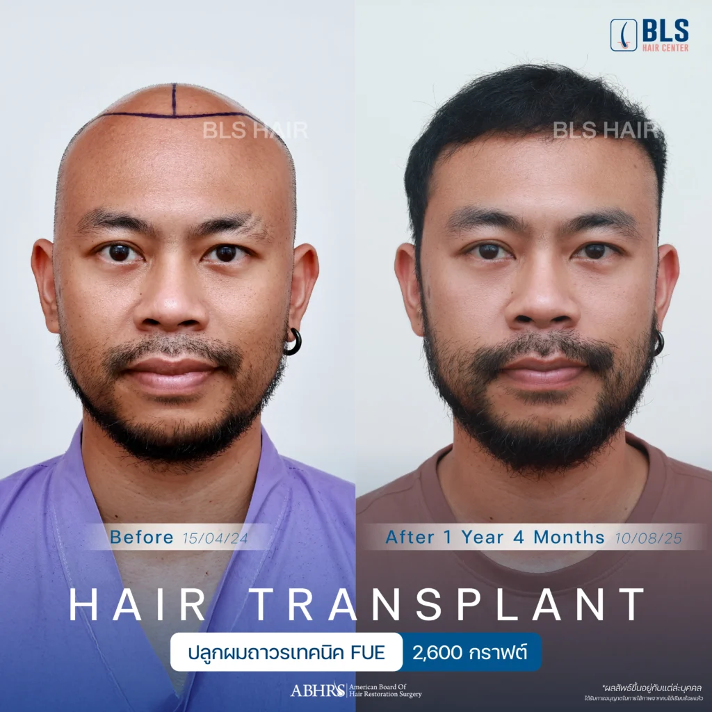 ชมรีวิวปลูกผมผู้ชาย แนวผมธรรมชาติ ดูดีขึ้น มั่นใจได้ที่ BLS Hair Center