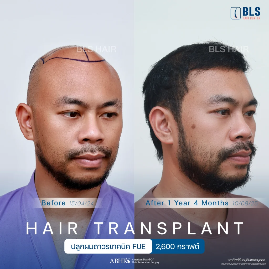 ชมรีวิวปลูกผมผู้ชาย แนวผมธรรมชาติ ดูดีขึ้น มั่นใจได้ที่ BLS Hair Center
