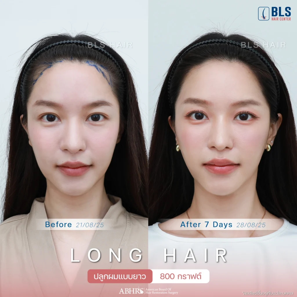 Review ปลูกผมผู้หญิง ที่ BLS Hair Center ปลูกผมถาวร รักษาผมร่วง ผมบาง โดยแพทย์อเมริกันบอร์ด