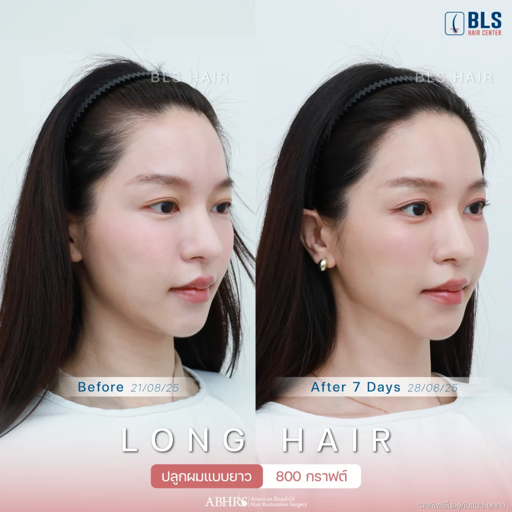 Review ปลูกผมผู้หญิง ที่ BLS Hair Center ปลูกผมถาวร รักษาผมร่วง ผมบาง โดยแพทย์อเมริกันบอร์ด