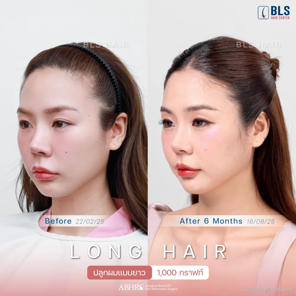 Review ปลูกผมผู้หญิง ที่ BLS Hair Center ปลูกผมถาวร รักษาผมร่วง ผมบาง โดยแพทย์อเมริกันบอร์ด