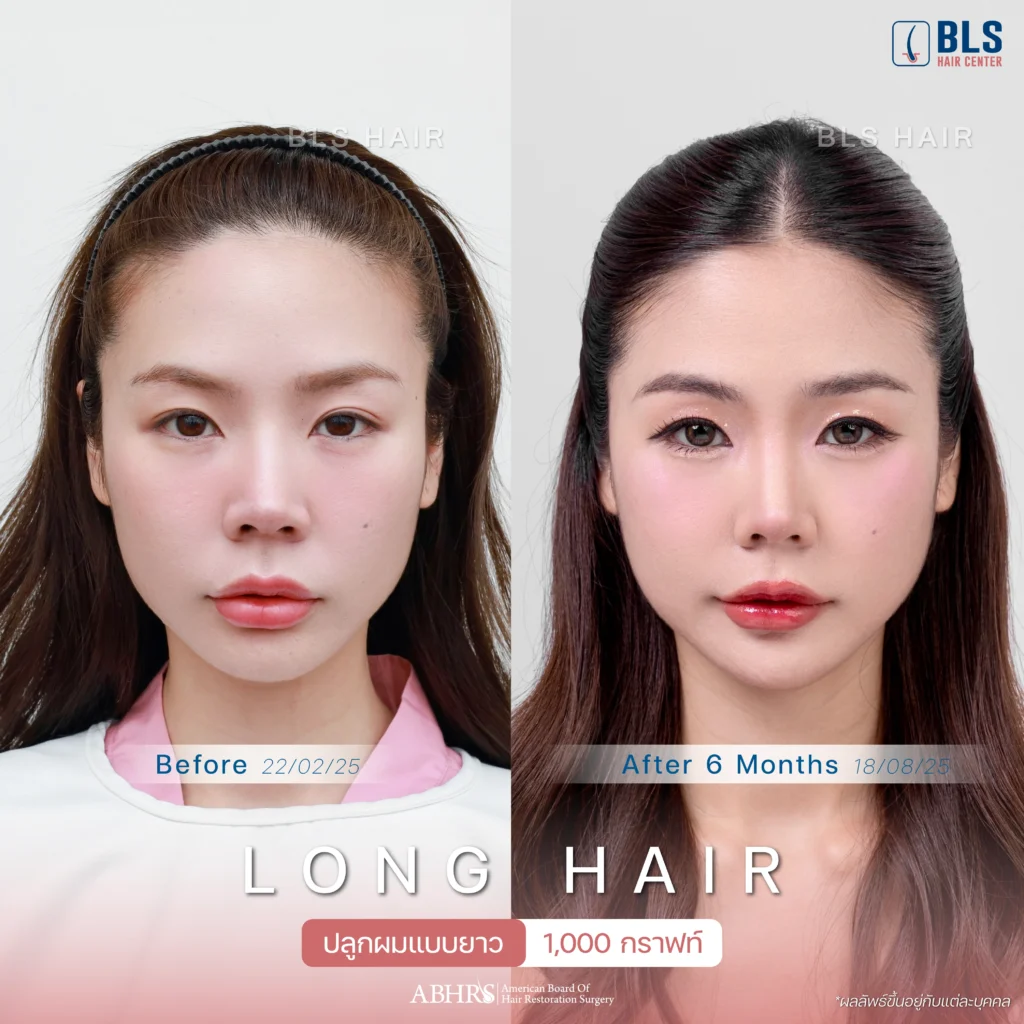 Review ปลูกผมผู้หญิง ที่ BLS Hair Center ปลูกผมถาวร รักษาผมร่วง ผมบาง โดยแพทย์อเมริกันบอร์ด