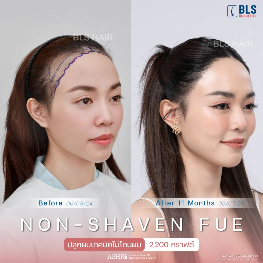 Review ปลูกผมผู้หญิง ที่ BLS Hair Center ปลูกผมถาวร รักษาผมร่วง ผมบาง โดยแพทย์อเมริกันบอร์ด
