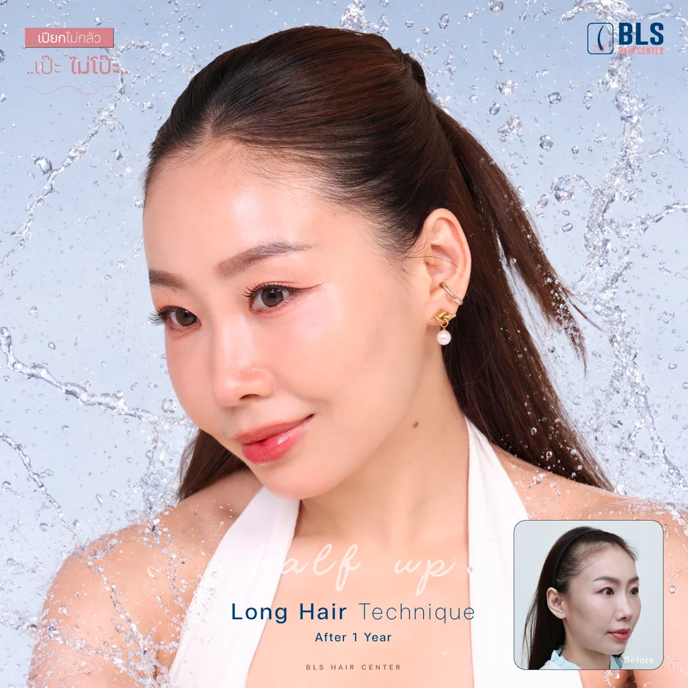 ปลูกผมถาวร แก้ไรผมบาง