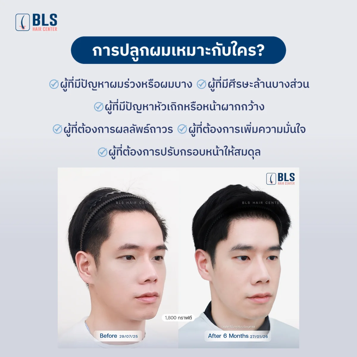 การปลูกผมเหมาะกับใคร?