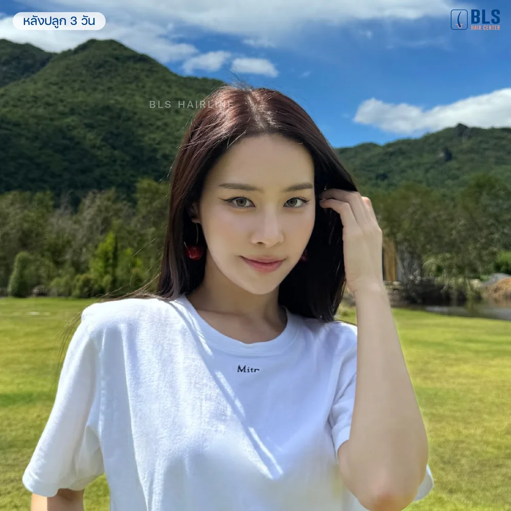 ปลูกผมผู้หญิง ปลูกผมไม่โกน