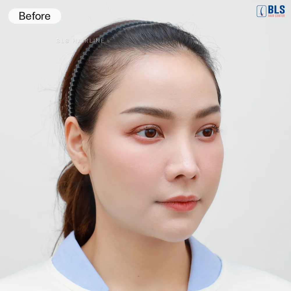 รีวิวปลูกผมยาว ผู้หญิง