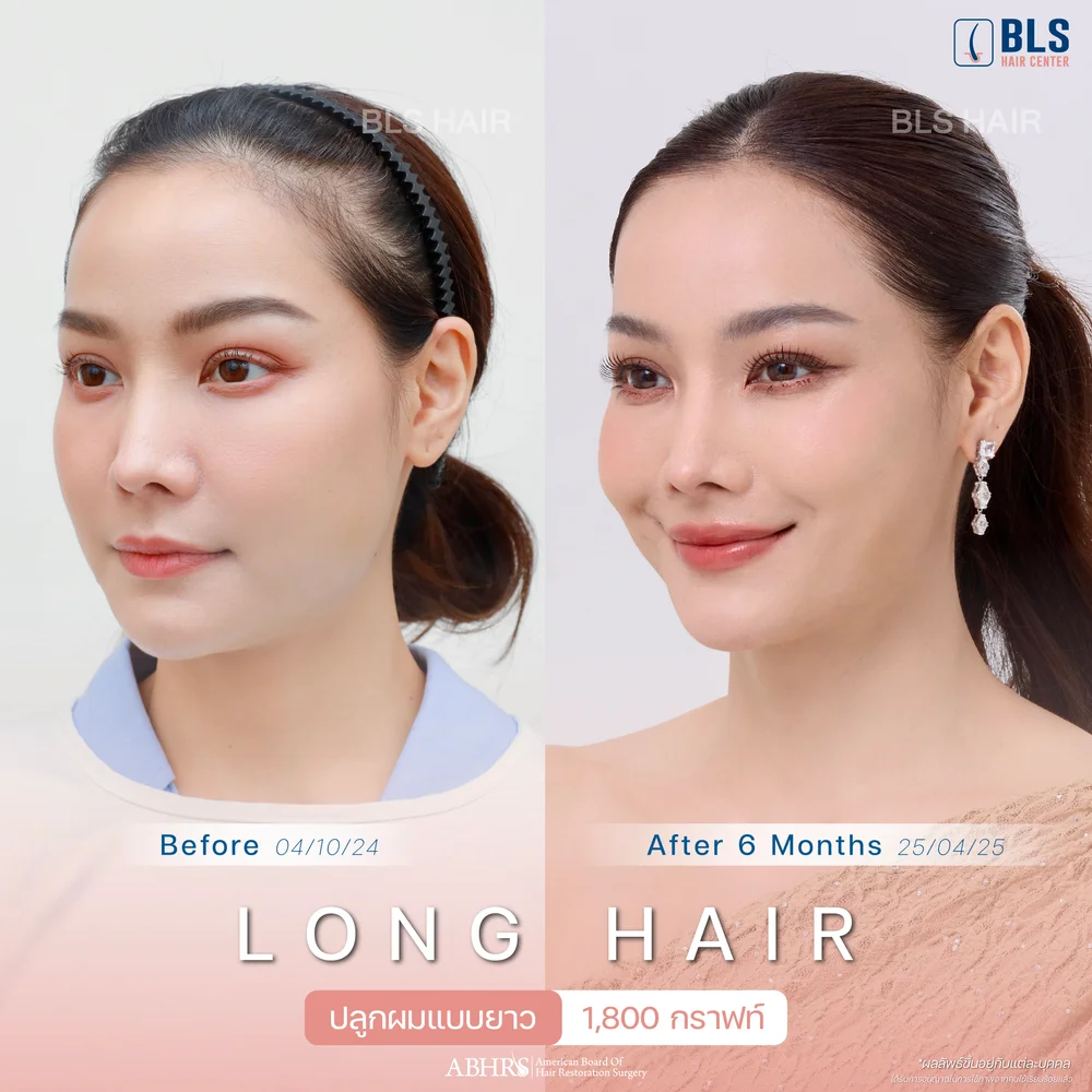 รีวิวปลูกผมยาว Long Hair