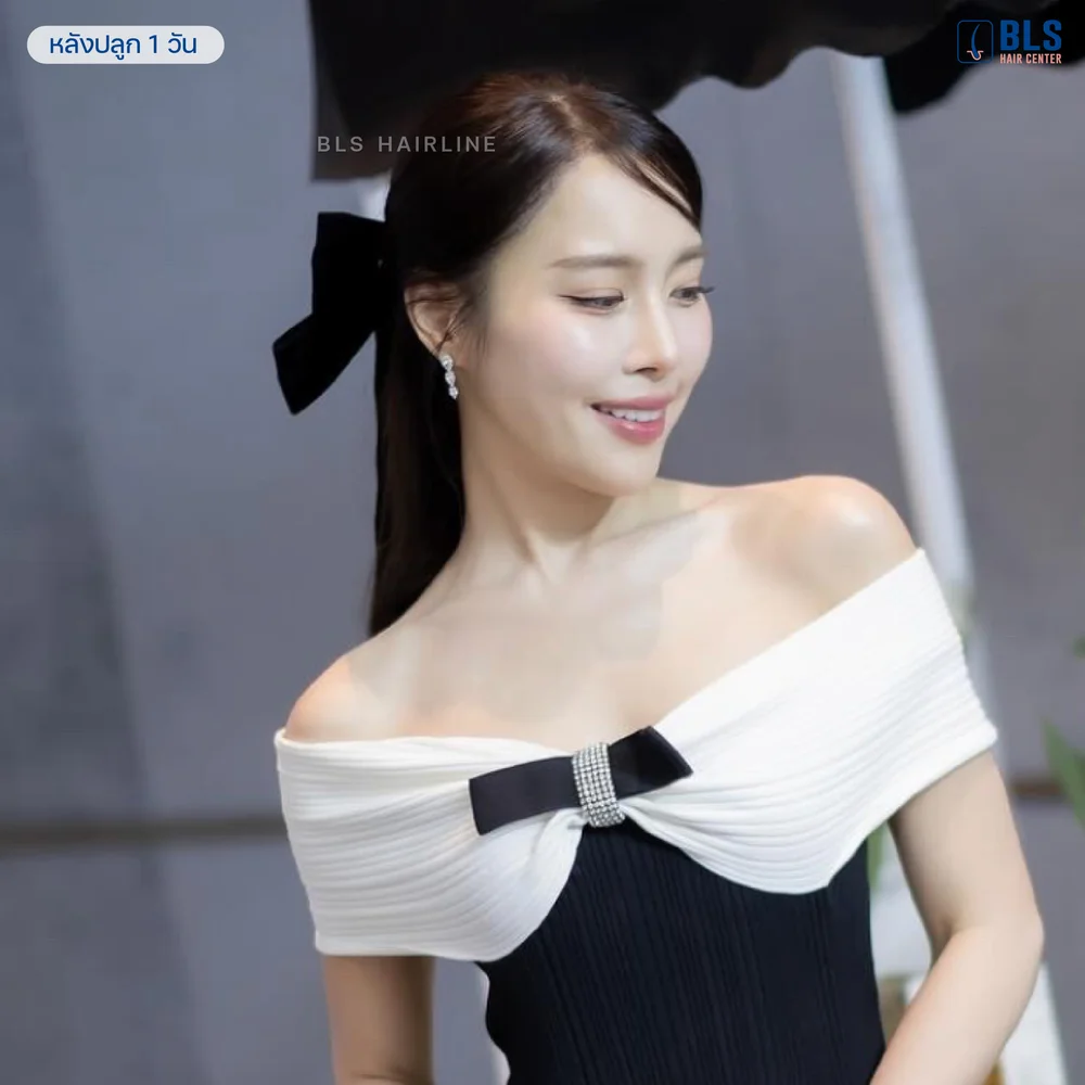 ปลูกผม Long Hair