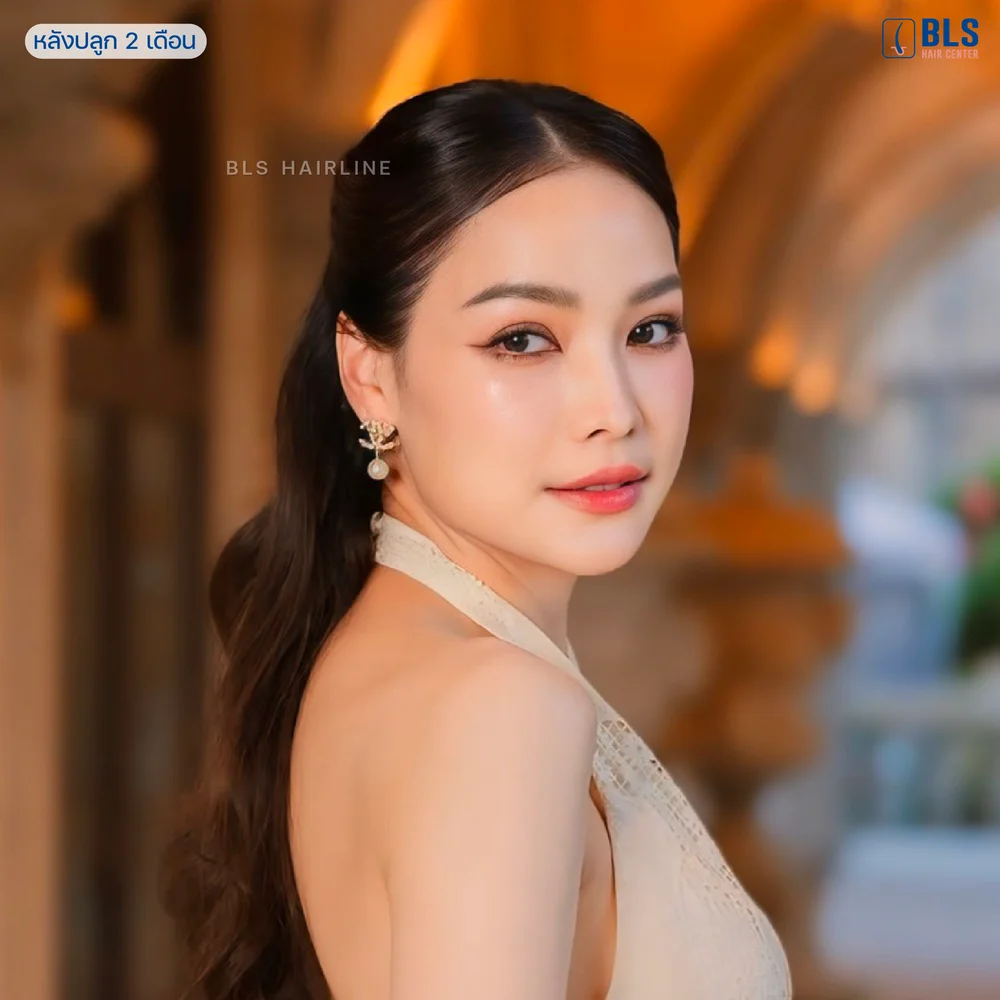 ปลูกผม Long Hair ข้อเสียไม่มี ข้อดี แนวผมธรรมชาติ