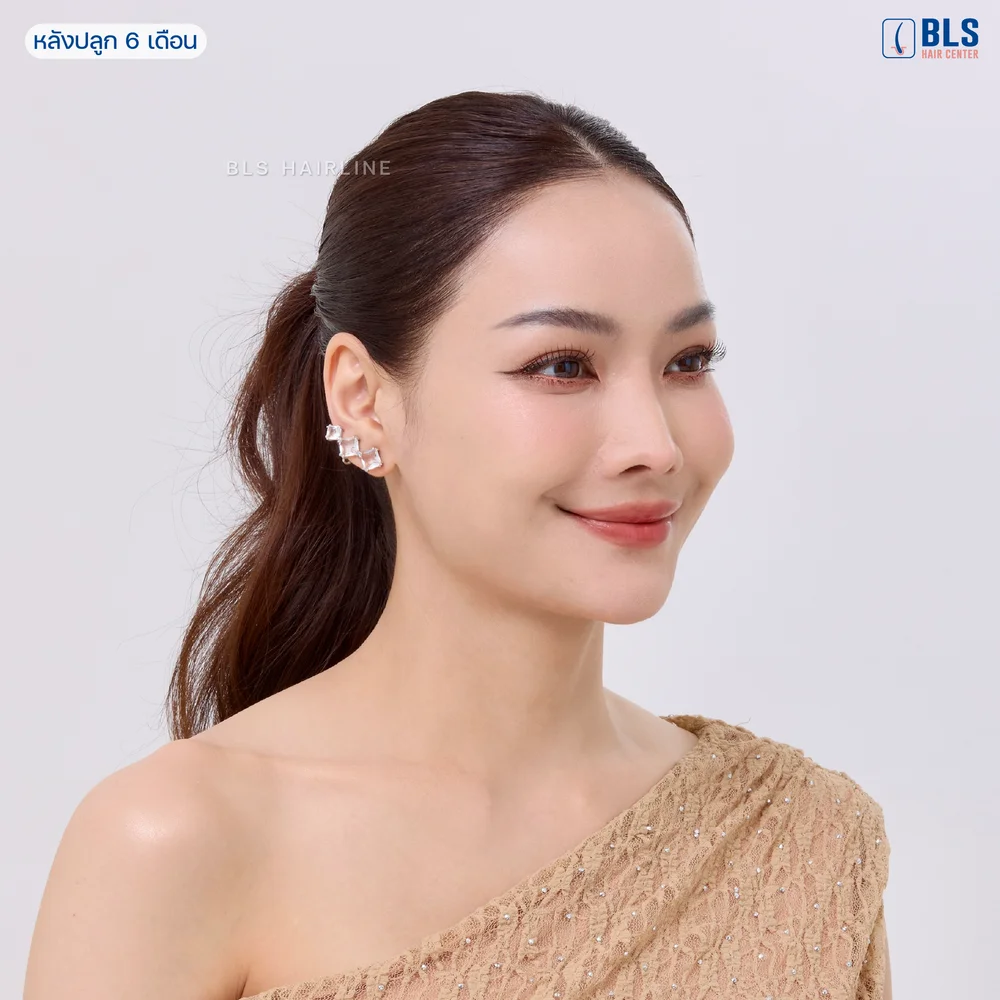 ปลูกผม Long Hair ราคาคุ้มค่า ที่ BLS Hair Center