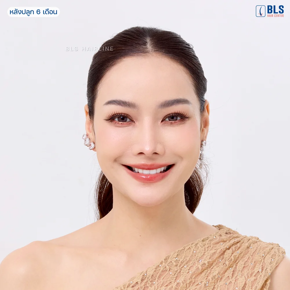ปลูกผม Long Hair คือคำตอบของปัญหากรอบหน้าไม่ชัด