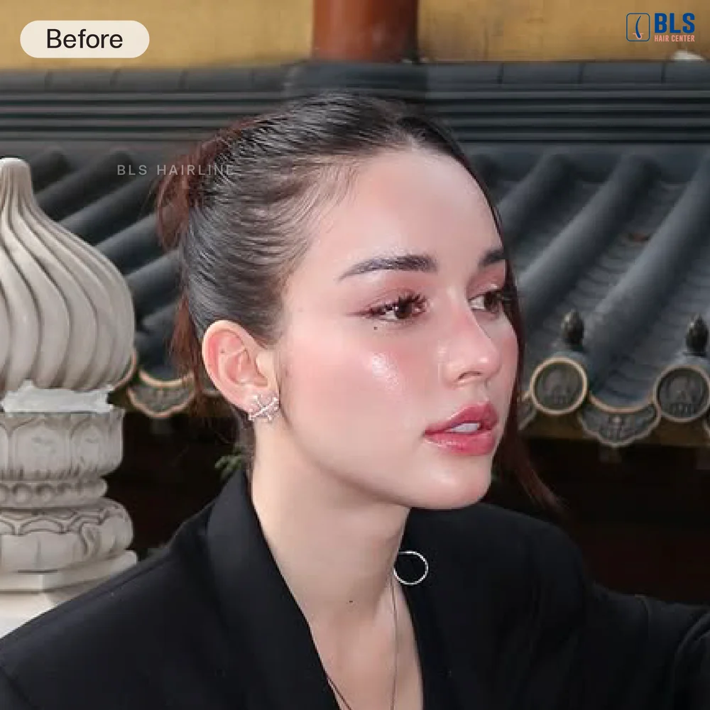 สกาย เดอะเฟซ รีวิวดาราปลูกผม Long Hair