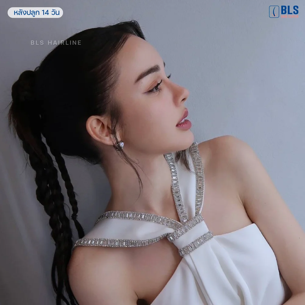 สกาย เดอะเฟซ หลังปลูกผมยาว ที่ BLS โดยแพทย์ ABHRS