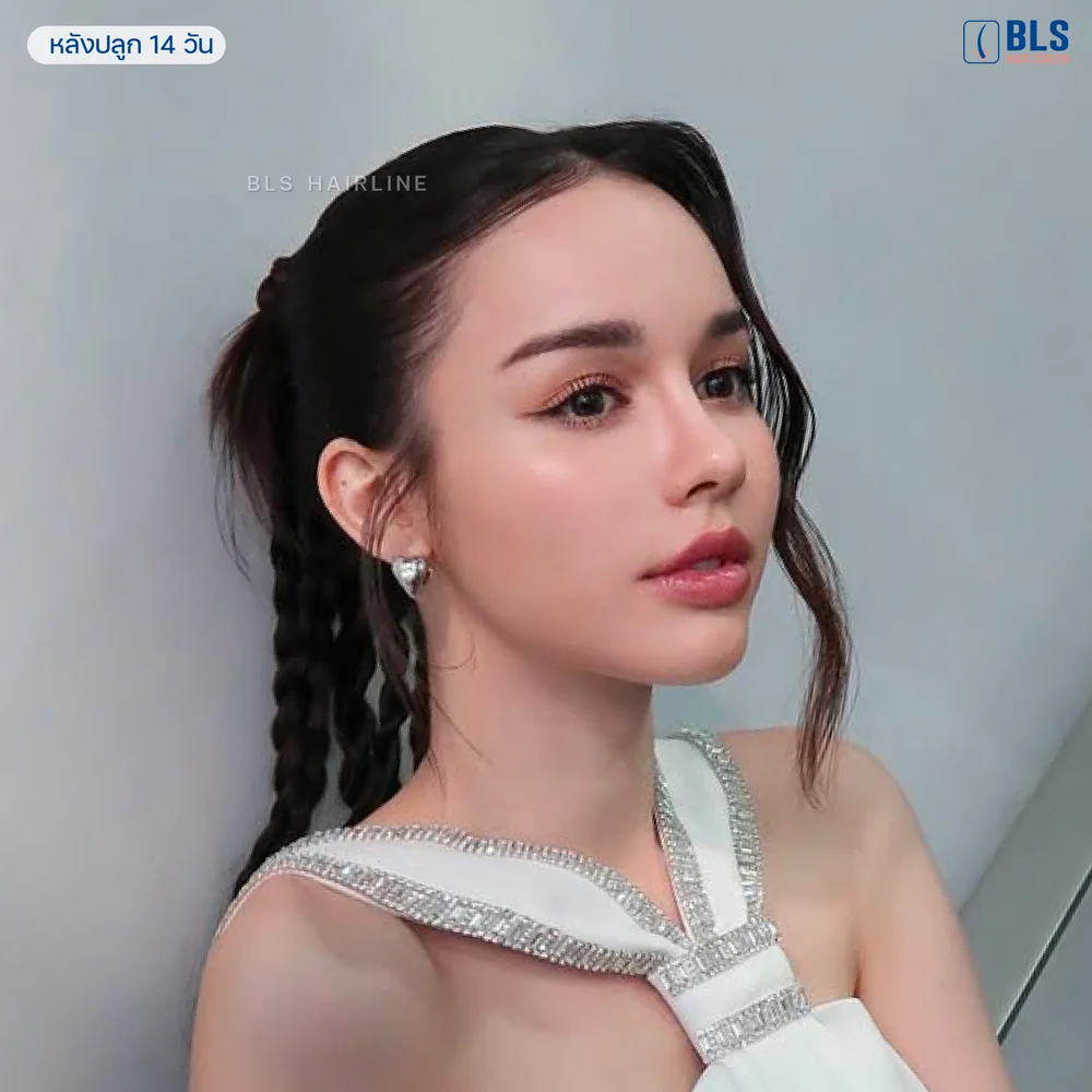 ปลูกผมยาว แนวผมดูธรรมชาติ สกายแนะนำ BLS