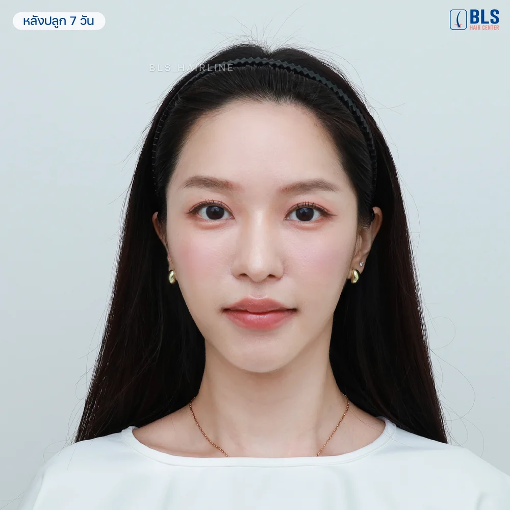 ปลูกผมยาว ดีจริงไหม ให้รีวิวเตยพริม เป็นคำตอบ