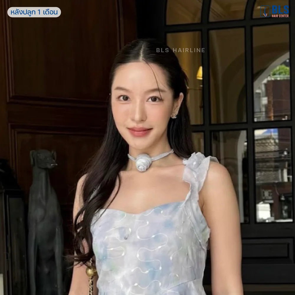 ปลูกผมยาว แนวผมดูธรรมชาติ ที่ BLS