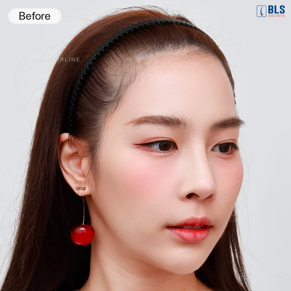 ผมบาง ปรึกษาปลูกผมผู้หญิง ที่ BLS Hair Center