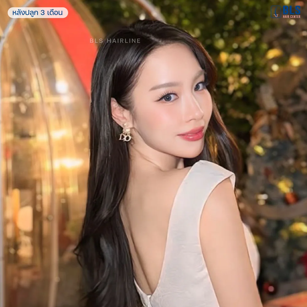 ปลูกผม Hair Transplant Bangkok