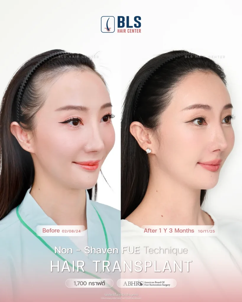 ปลูกผมอยู่ได้กี่ปี เส้นผมอยู่ได้กี่ปี รู้ได้ไงว่ากราฟผมหลุด