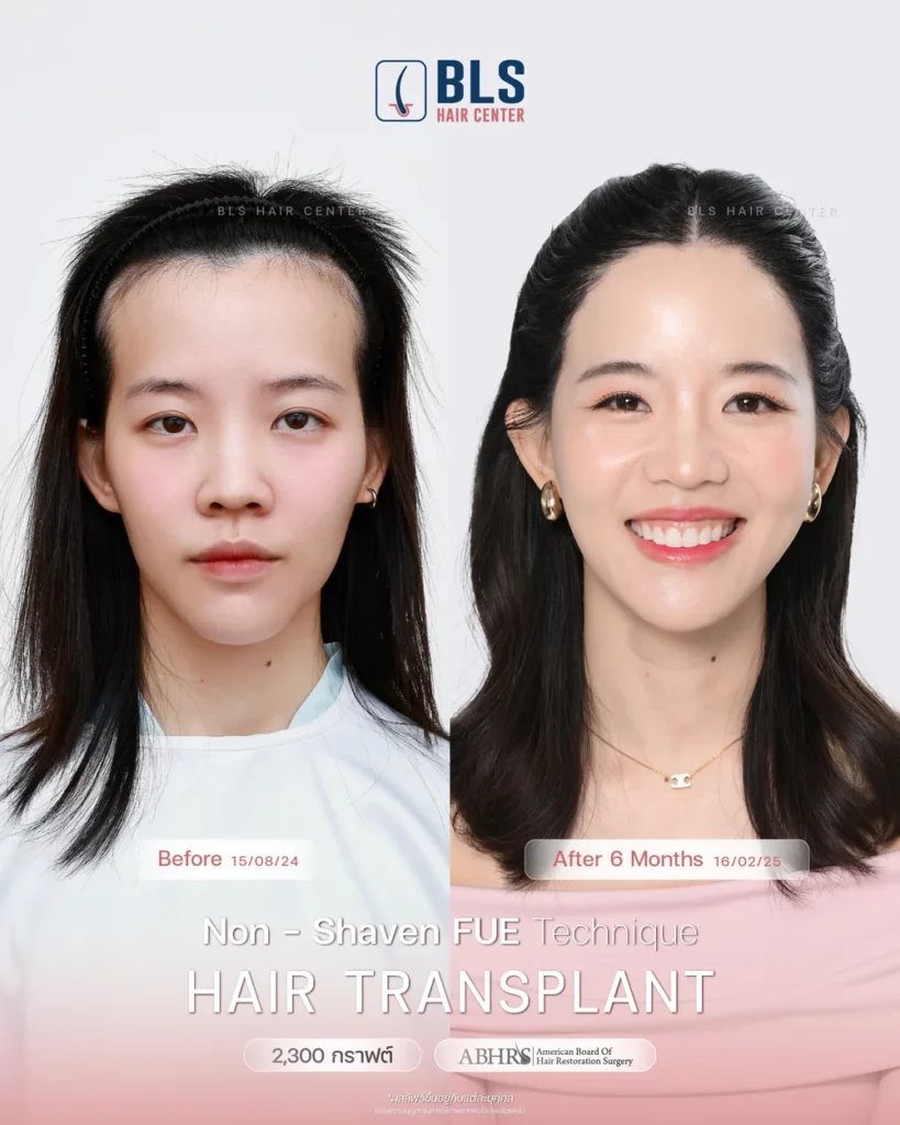 ปลูกผมอยู่ได้กี่ปี เส้นผมอยู่ได้กี่ปี รู้ได้ไงว่ากราฟผมหลุด