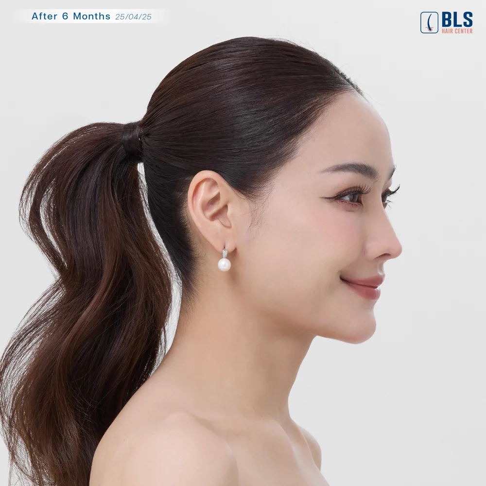 ผมบาง ปลูกผมไม่โกน ปลูกผม Long Hair ราคา ปลูกผม Long Hair ข้อเสีย