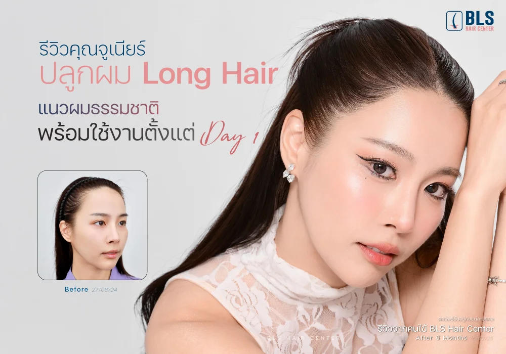 รีวิวคุณจูเนียร์ ปลูกผม Long Hair เติมกรอบหน้าให้มั่นใจ แบบไม่ต้องโกนผม