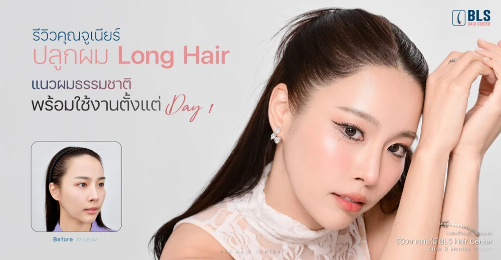 รีวิวคุณจูเนียร์ ปลูกผม Long Hair เติมกรอบหน้าให้มั่นใจ แบบไม่ต้องโกนผม