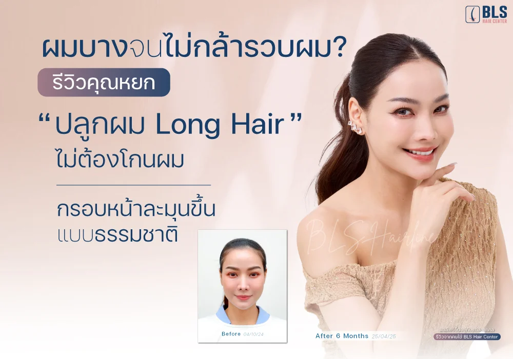 ผมบางจนไม่กล้ารวบผม? รีวิวคุณหยก "ปลูกผม Long Hair" ไม่ต้องโกนผม