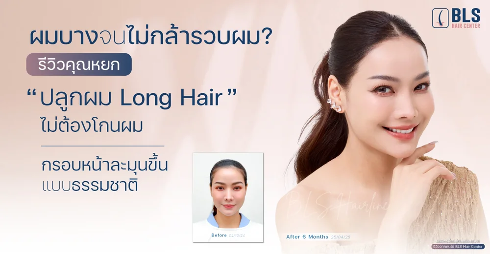 ผมบางจนไม่กล้ารวบผม? รีวิวคุณหยก "ปลูกผม Long Hair" ไม่ต้องโกนผม