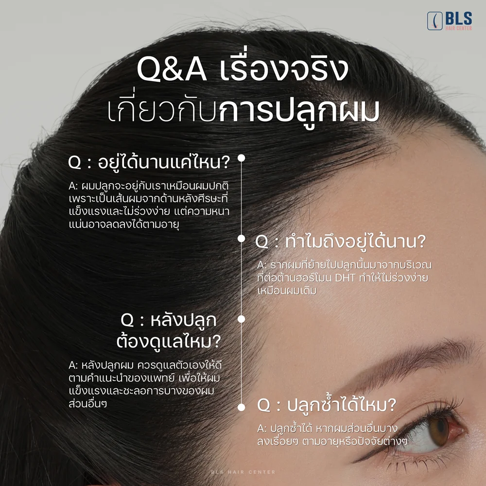 เรื่องจริงของการปลูกผม ปลูกผมอยู่ได้นานแค่ไหน