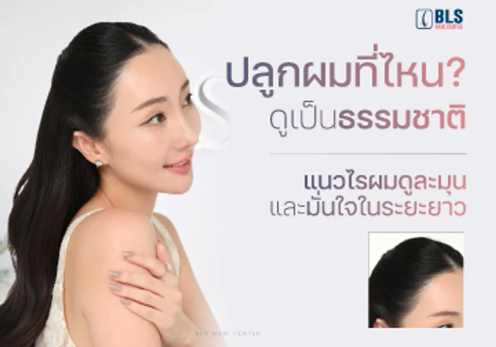 ปลูกผมที่ไหน? ดูเป็นธรรมชาติ ให้แนวไรผมดูละมุน และมั่นใจในระยะยาว