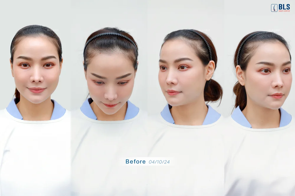 ปลูกผมที่ไหนดี ในกรุงเทพ Hair Transplant Bangkok