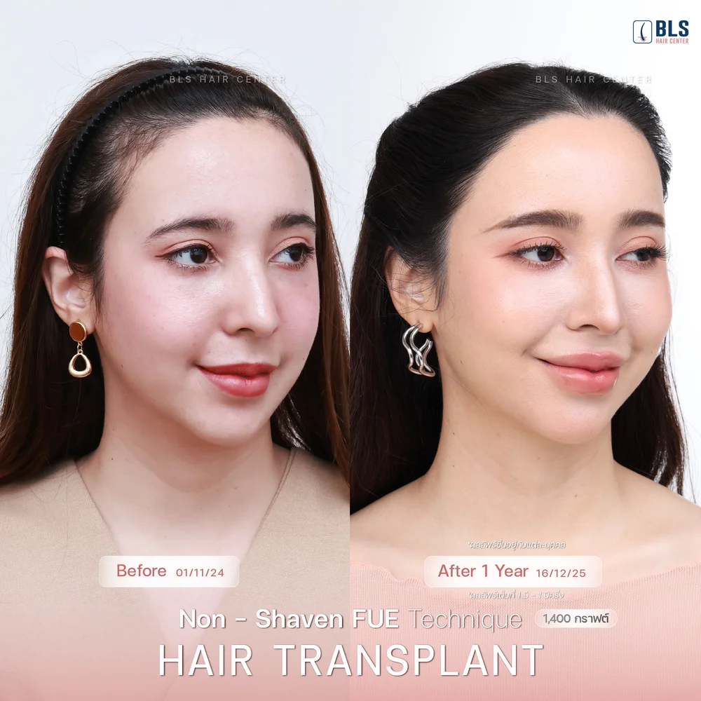ปลูกผม Hair Transplant Thailand ปลูกผมไม่ต้องโกน