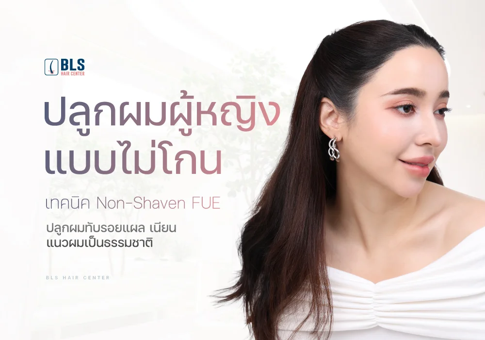 ปลูกผมผู้หญิงแบบไม่โกน เทคนิค Non-Shaven FUE ปลูกผมทับรอยแผล เนียน แนวผมเป็นธรรมชาติ