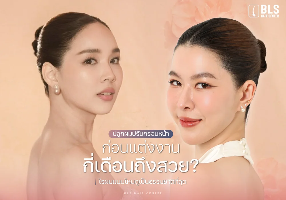 ปลูกผมปรับกรอบหน้า ก่อนแต่งงาน กี่เดือนถึงสวย? ไรผมแบบไหนดูเป็นธรรมชาติที่สุด
