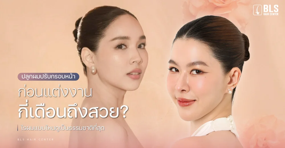 ปลูกผมปรับกรอบหน้า ก่อนแต่งงาน กี่เดือนถึงสวย? ไรผมแบบไหนดูเป็นธรรมชาติที่สุด