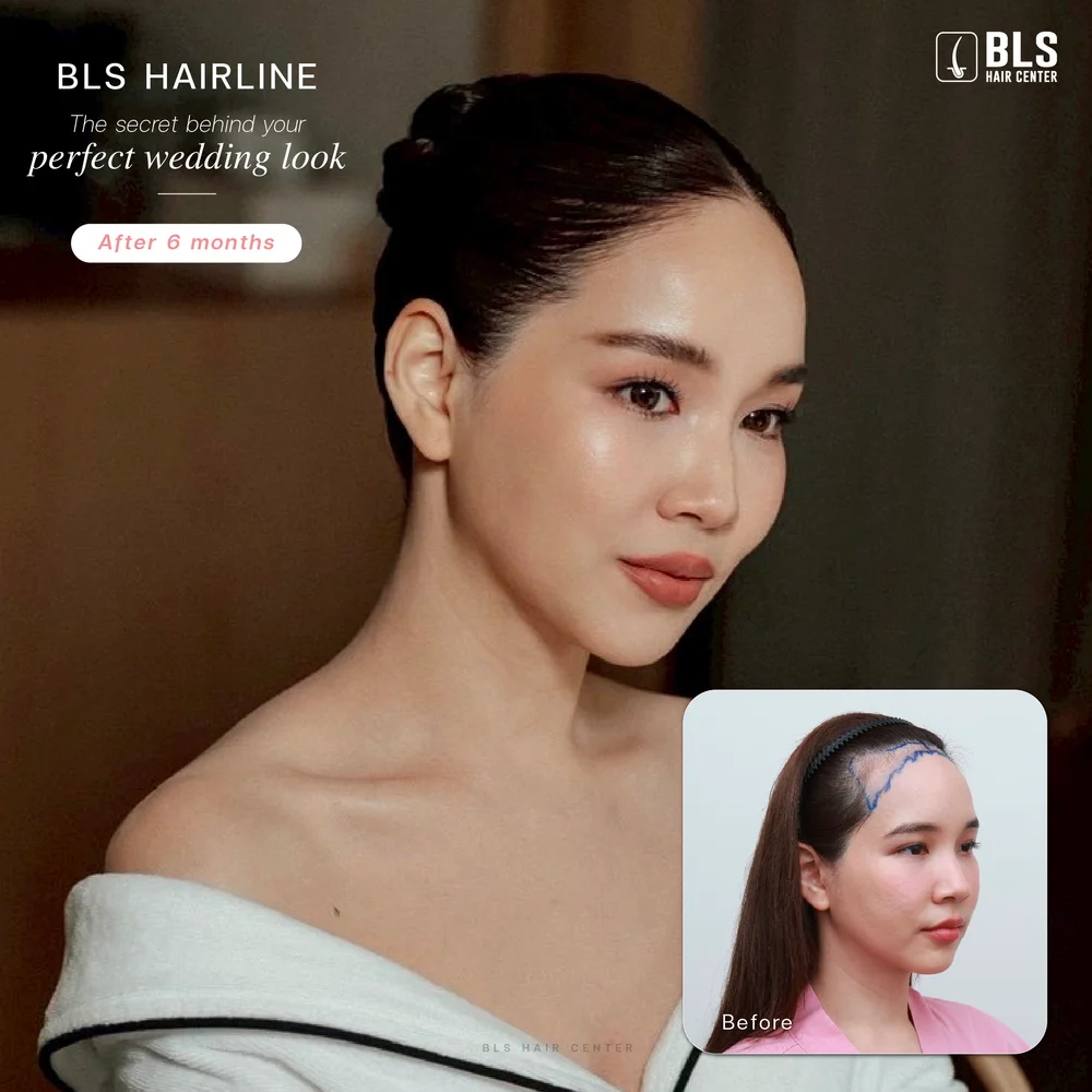 ผมบาง แนะนำเทคนิคปลูกผมที่นิยมสำหรับผู้หญิง Female Hairline