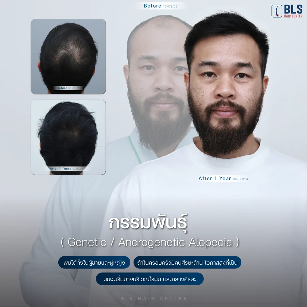 ผมยาวช้า เกิดจากอะไร ผู้ชาย