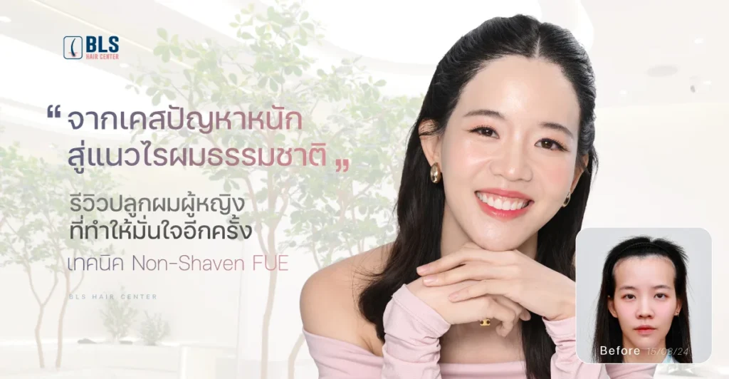 จากเคสปัญหาหนัก สู่แนวไรผมธรรมชาติ รีวิวปลูกผมผู้หญิงที่ทำให้มั่นใจอีกครั้ง ด้วยเทคนิค Non-Shaven FUE
